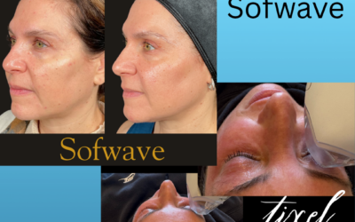 Sofwave vs. Tixel: What’s the Difference and Which Treatment Is Right for Your Skin?