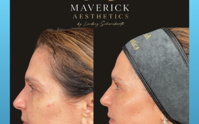 Can Sofwave Improve Skin Laxity Without Surgery?